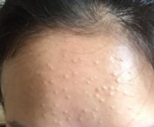 天津青春痘哪个医院好