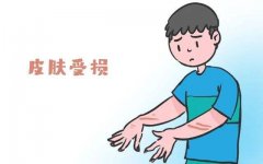 什么是牛皮癣呢